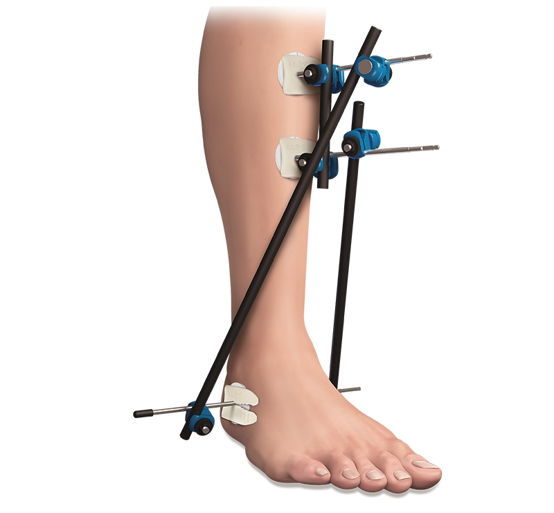 Arthrex - JumpStart, Antimicrobial Composite Wound Dressing
